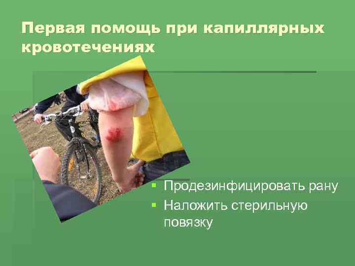 Первая помощь при капиллярных кровотечениях § Продезинфицировать рану § Наложить стерильную повязку 