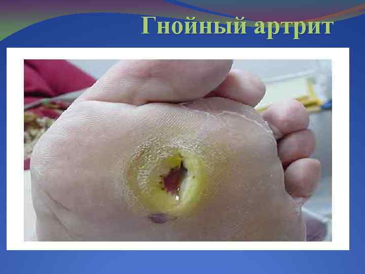 Гнойный артрит 