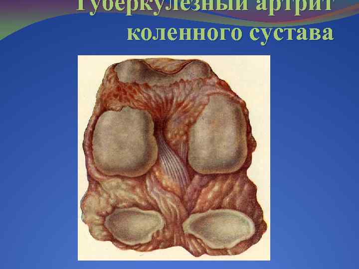 Туберкулезный артрит коленного сустава 