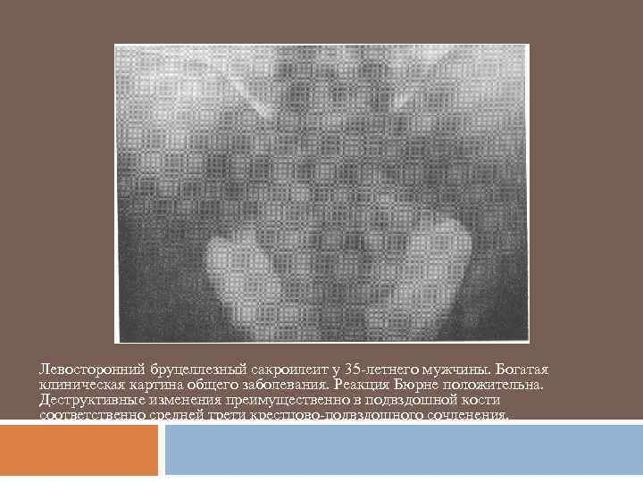 Левосторонний бруцеллезный сакроилеит у 35 -летнего мужчины. Богатая клиническая картина общего заболевания. Реакция Бюрне