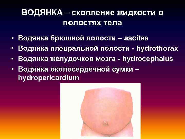 ВОДЯНКА – скопление жидкости в полостях тела • • Водянка брюшной полости – ascites