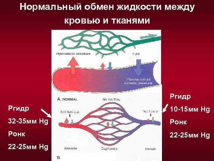 Нормальный обмен жидкости между кровью и тканями Ргидр 10 -15 мм Hg 32 -35