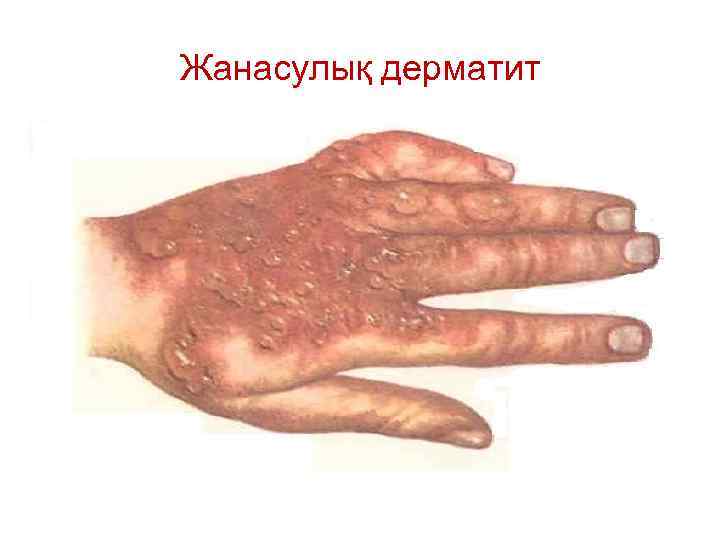 Жанасулық дерматит 