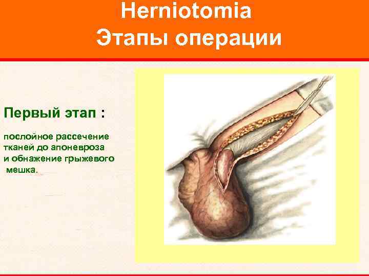 Herniotomia Этапы операции Первый этап : послойное рассечение тканей до апоневроза и обнажение грыжевого