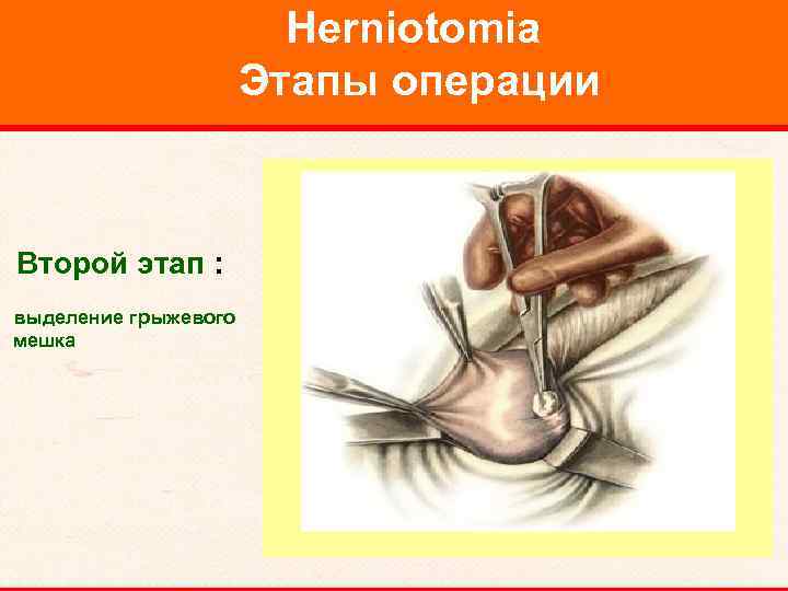 Herniotomia Этапы операции Второй этап : выделение грыжевого мешка 