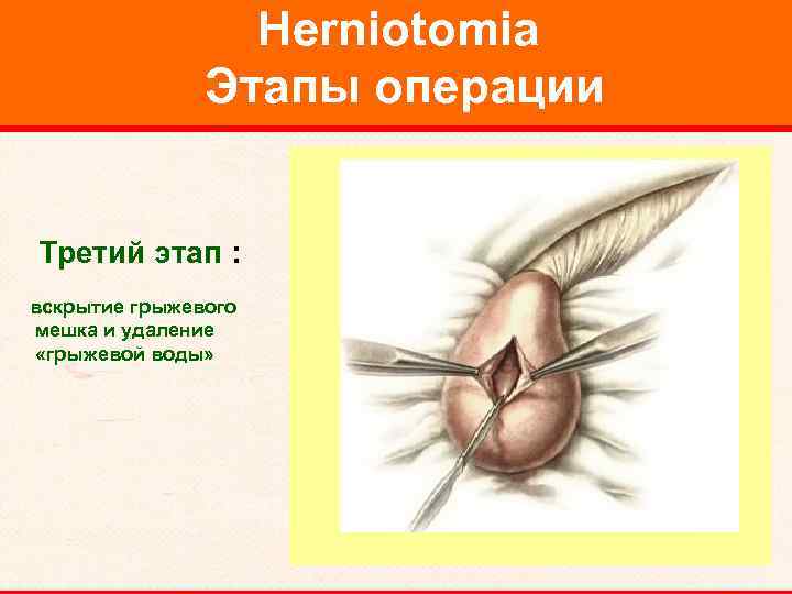 Herniotomia Этапы операции Третий этап : вскрытие грыжевого мешка и удаление «грыжевой воды» 