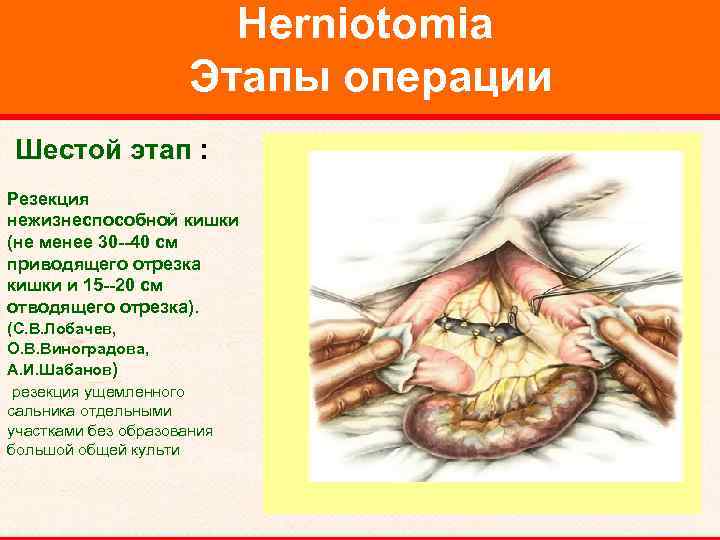 Herniotomia Этапы операции Шестой этап : Резекция нежизнеспособной кишки (не менее 30 --40 см