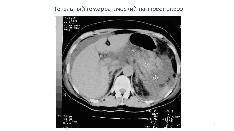 Панкреонекроз рекомендации