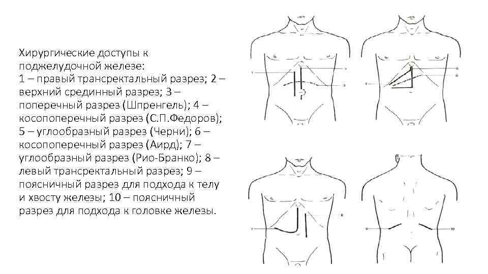 Нижне-средне-срединная лапаротомия. Трансректальный разрез. Разрез Шпренгеля. Верхняя срединная лапаротомия.