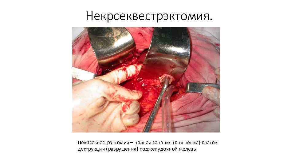 Некрсеквестрэктомия. Некрсеквестрэктомия – полная санация (очищение) очагов деструкции (разрушения) поджелудочной железы 