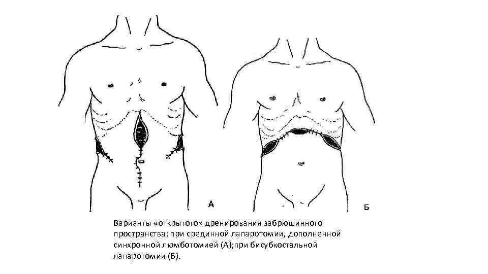 Нижняя лапаротомия