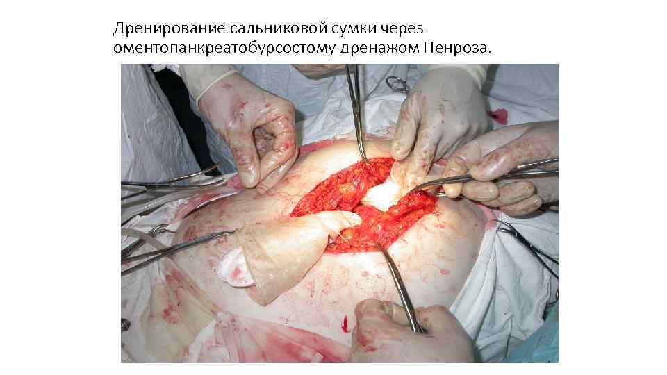 Дренирование сальниковой сумки через оментопанкреатобурсостому дренажом Пенроза. 