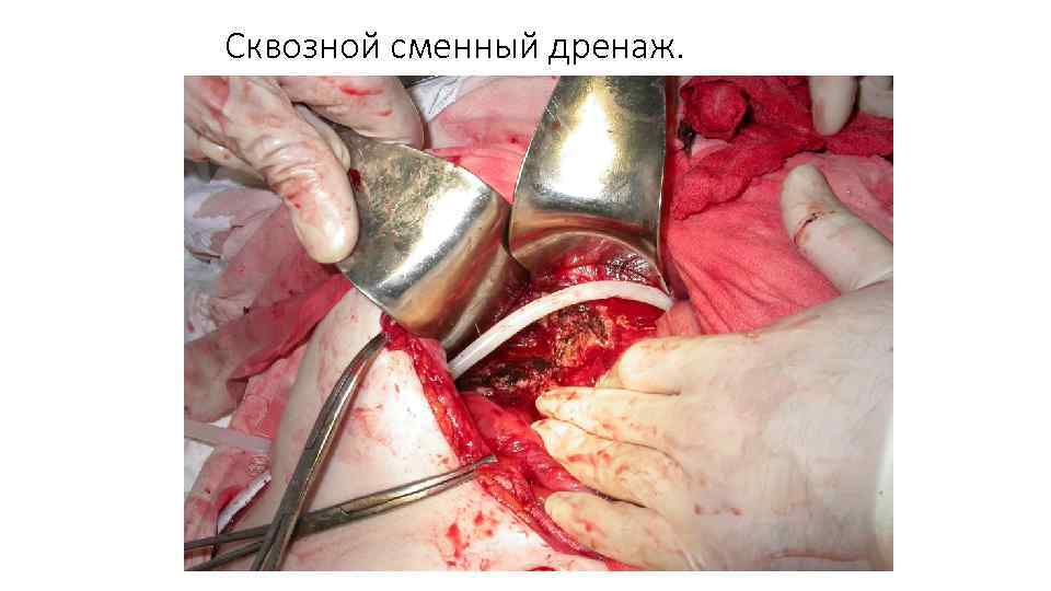 Сквозной сменный дренаж. 