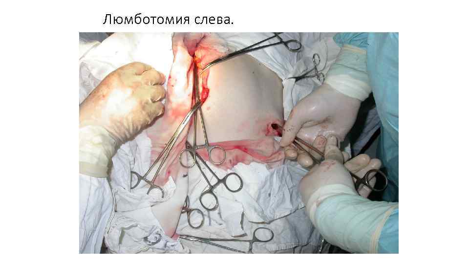 Люмботомия слева. 