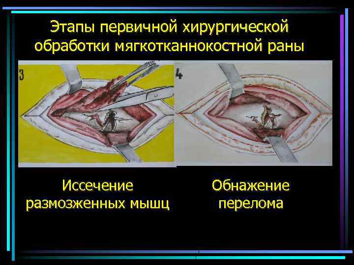 Этапы первичной хирургической обработки мягкотканнокостной раны Иссечение размозженных мышц Обнажение перелома 