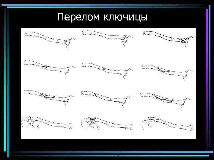 Перелом ключицы 