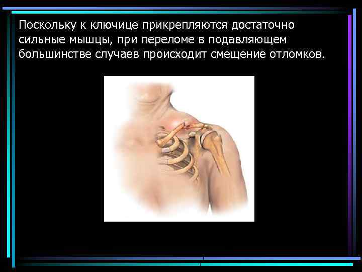 Поскольку к ключице прикрепляются достаточно сильные мышцы, при переломе в подавляющем большинстве случаев происходит