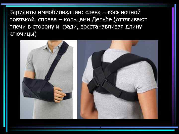 Варианты иммобилизации: слева – косыночной повязкой, справа – кольцами Дельбе (оттягивают плечи в сторону