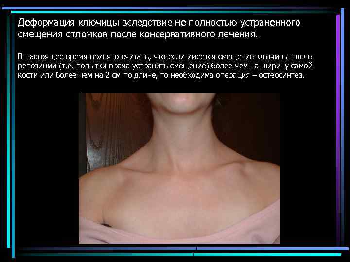 Деформация ключицы вследствие не полностью устраненного смещения отломков после консервативного лечения. В настоящее время