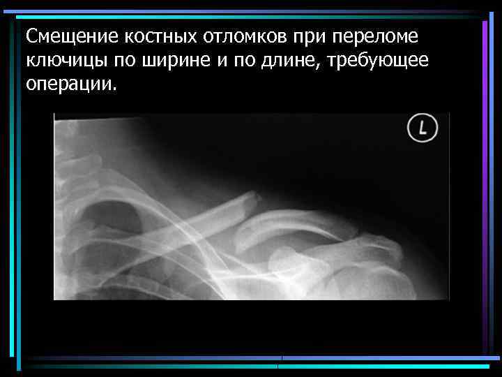 Смещение костных отломков при переломе ключицы по ширине и по длине, требующее операции. 