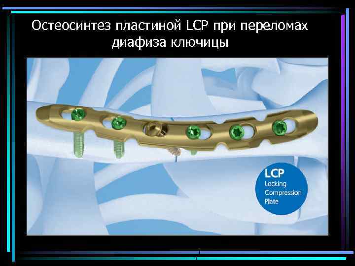 Остеосинтез пластиной LCP при переломах диафиза ключицы 