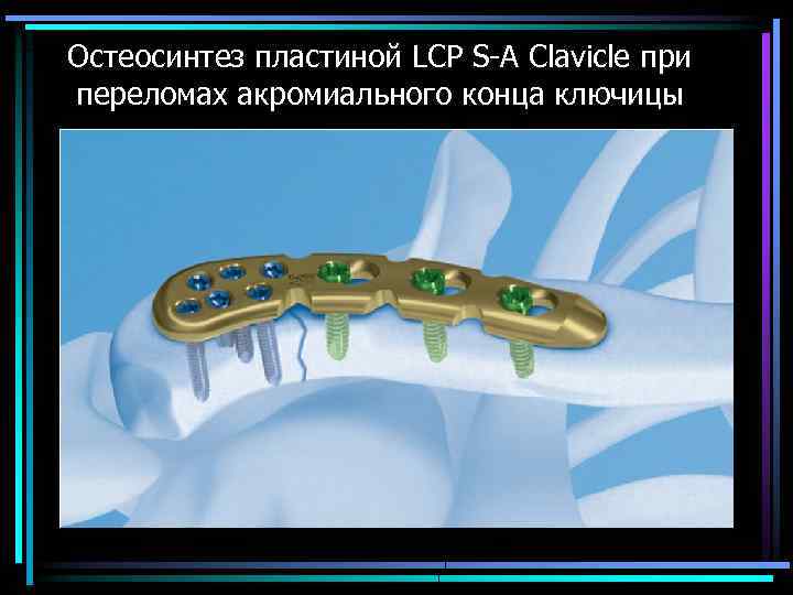 Остеосинтез пластиной LCP S A Clavicle при переломах акромиального конца ключицы 