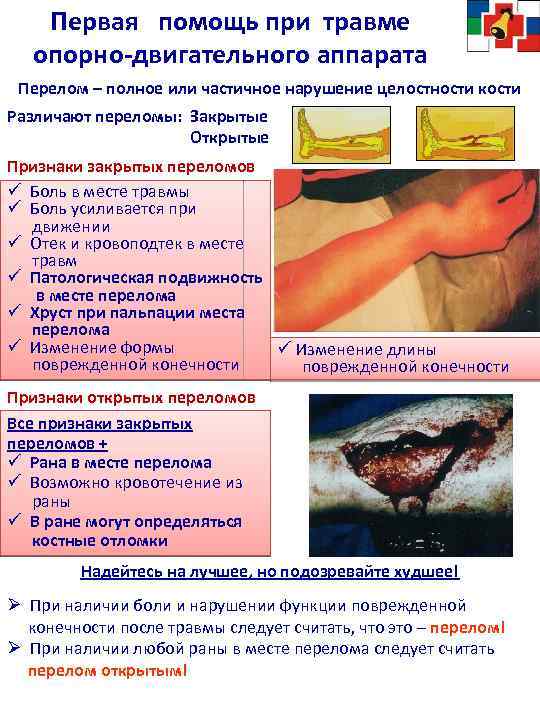 Первая помощь при травме опорно-двигательного аппарата Перелом – полное или частичное нарушение целостности кости