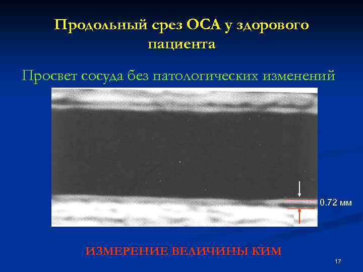 Продольный срез ОСА у здорового пациента Просвет сосуда без патологических изменений 0. 72 мм