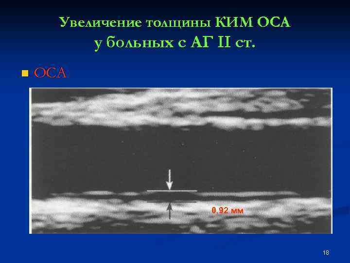 Увеличение толщины КИМ ОСА у больных с АГ II ст. n ОСА 0, 92