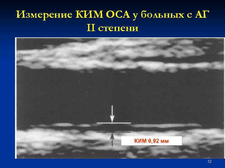 Измерение КИМ ОСА у больных с АГ II степени КИМ 0, 92 мм 12