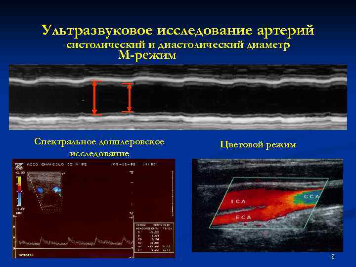 Ультразвуковое исследование артерий систолический и диастолический диаметр М-режим Спектральное допплеровское исследование Цветовой режим 6