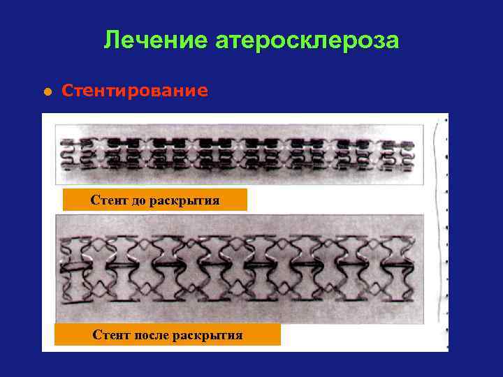 Лечение атеросклероза l Стентирование Стент до раскрытия Стент после раскрытия 