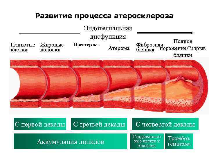 Стадии атеросклероза картинки