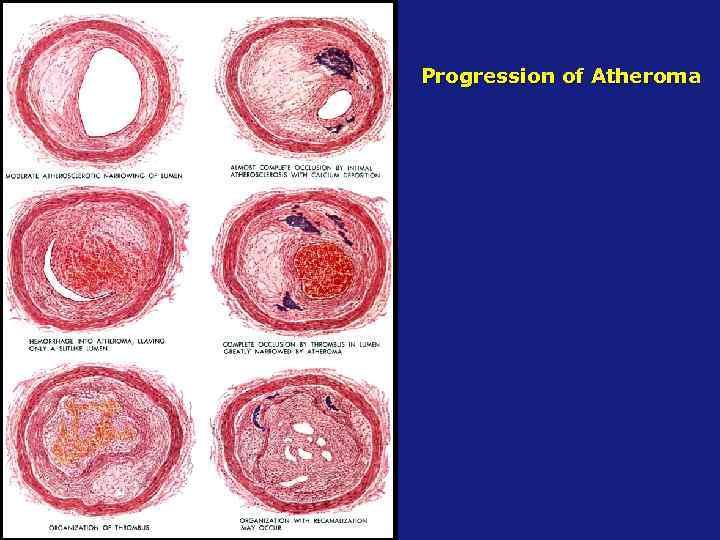 Progression of Atheroma 