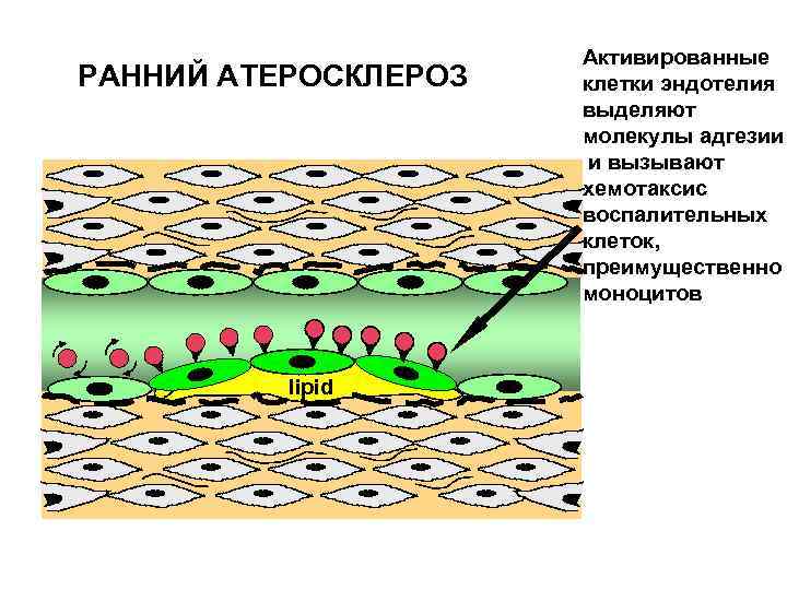 РАННИЙ АТЕРОСКЛЕРОЗ lipid Активированные клетки эндотелия выделяют молекулы адгезии и вызывают хемотаксис воспалительных клеток,