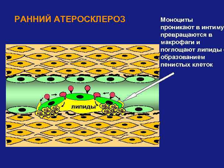 РАННИЙ АТЕРОСКЛЕРОЗ липиды Моноциты проникают в интиму превращаются в макрофаги и поглощают липиды с