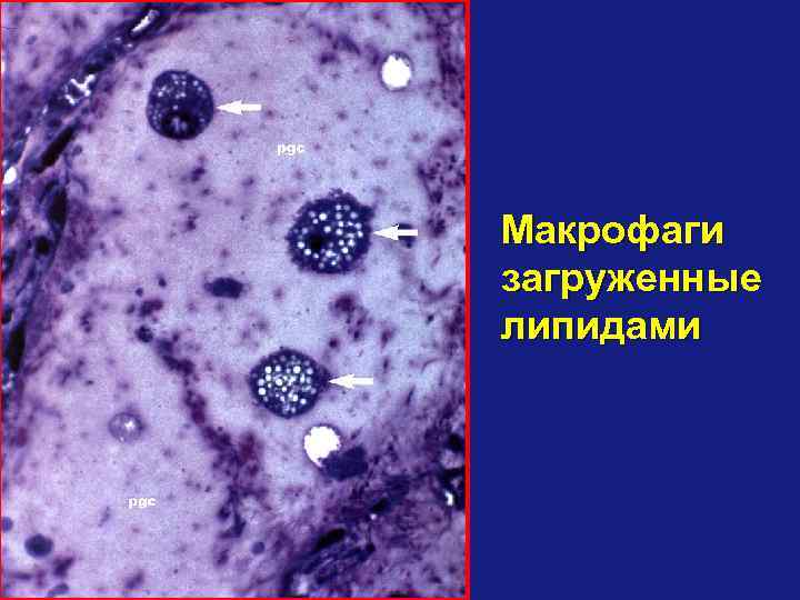 Макрофаги загруженные липидами 