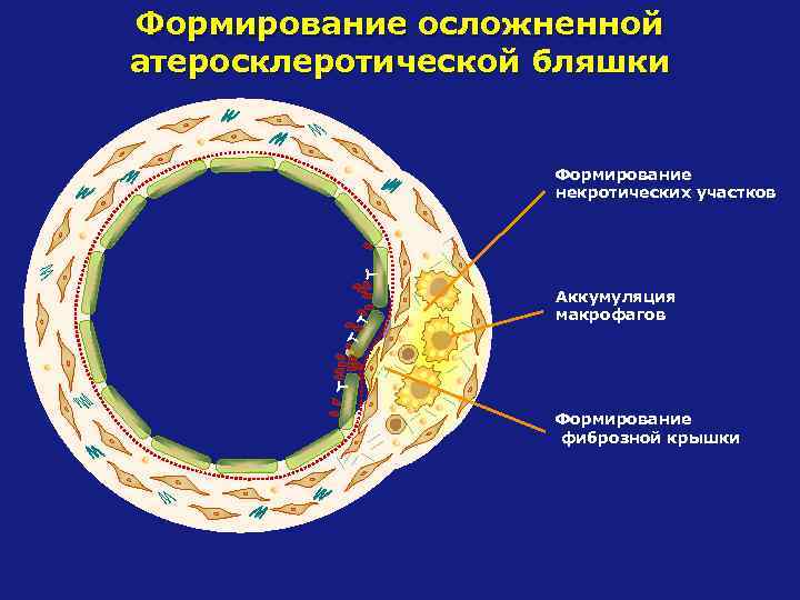 Формирование осложненной атеросклеротической бляшки Формирование некротических участков Аккумуляция макрофагов Формирование фиброзной крышки 