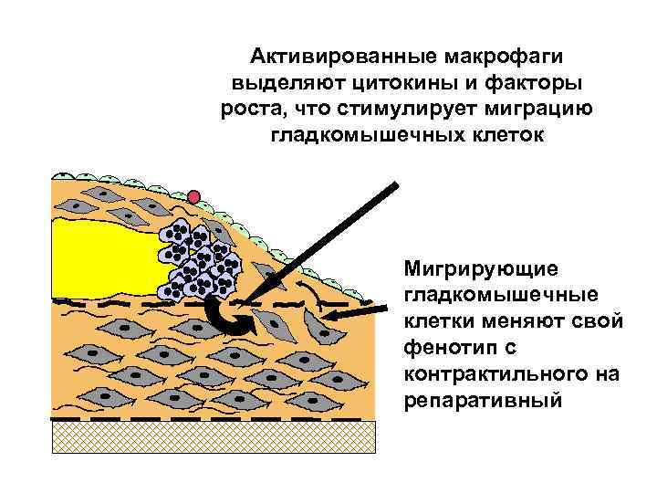 Активированные макрофаги выделяют цитокины и факторы роста, что стимулирует миграцию гладкомышечных клеток Мигрирующие гладкомышечные