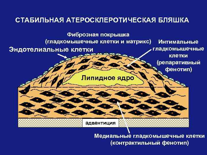 СТАБИЛЬНАЯ АТЕРОСКЛЕРОТИЧЕСКАЯ БЛЯШКА Фиброзная покрышка (гладкомышечные клетки и матрикс) Эндотелиальные клетки Интимальные гладкомышечные клетки