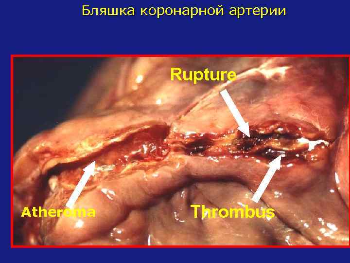 Бляшка коронарной артерии Rupture Atheroma Thrombus 