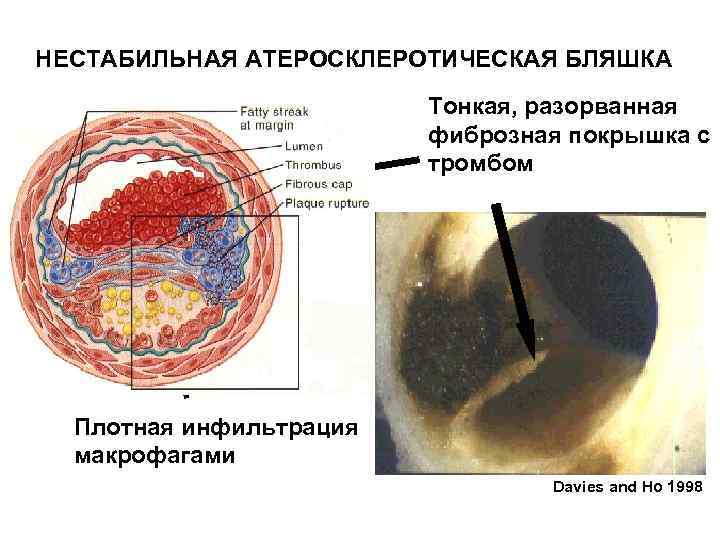 НЕСТАБИЛЬНАЯ АТЕРОСКЛЕРОТИЧЕСКАЯ БЛЯШКА Тонкая, разорванная фиброзная покрышка с тромбом Boyle et al. 1997 Плотная