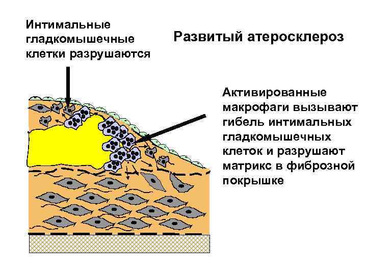 Интимальные гладкомышечные клетки разрушаются Развитый атеросклероз Активированные макрофаги вызывают гибель интимальных гладкомышечных клеток и