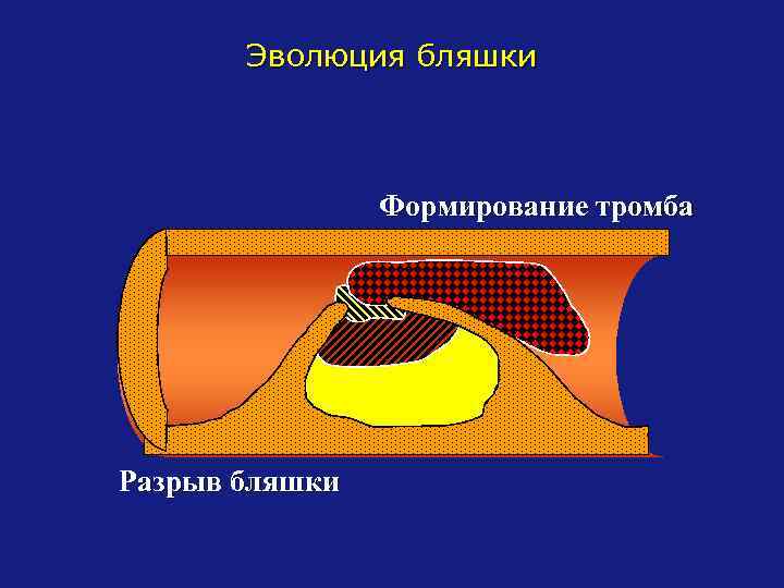 Эволюция бляшки Формирование тромба Разрыв бляшки 