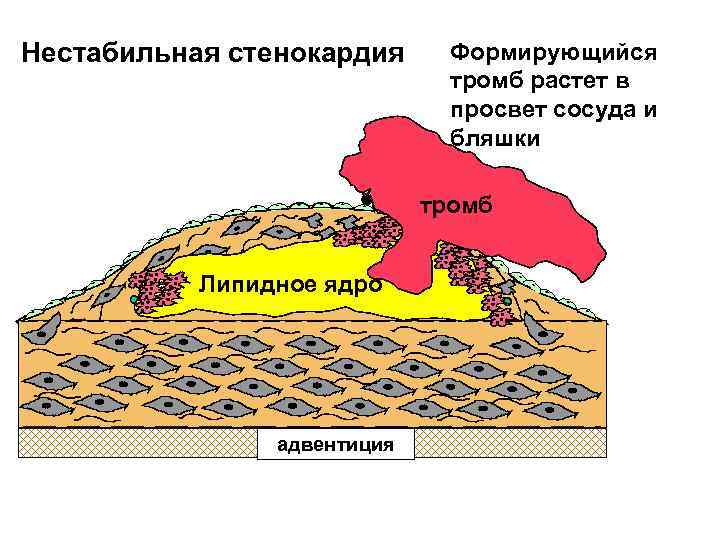 Нестабильная стенокардия Формирующийся тромб растет в просвет сосуда и бляшки тромб lipid core Липидное