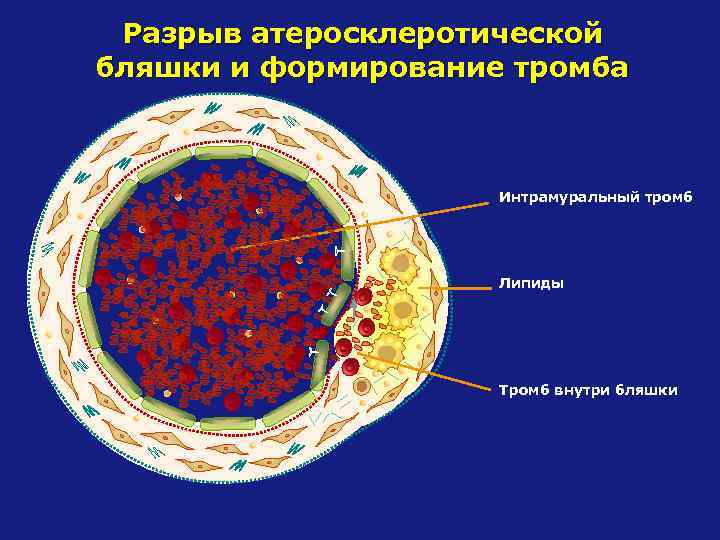 Разрыв атеросклеротической бляшки и формирование тромба Интрамуральный тромб Липиды Тромб внутри бляшки 