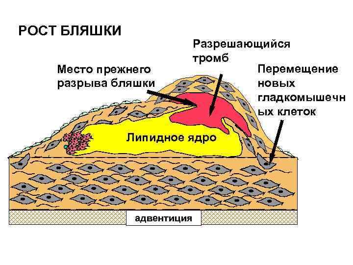 РОСТ БЛЯШКИ Место прежнего разрыва бляшки Разрешающийся тромб Перемещение новых гладкомышечн ых клеток lipid