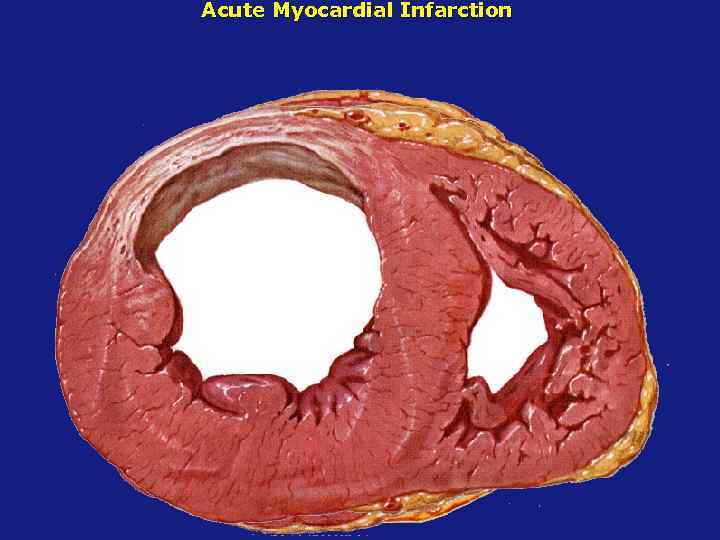 Acute Myocardial Infarction 