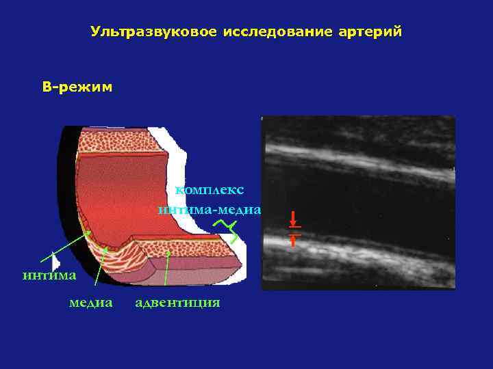 Ультразвуковое исследование артерий В-режим комплекс интима-медиа интима медиа адвентиция 