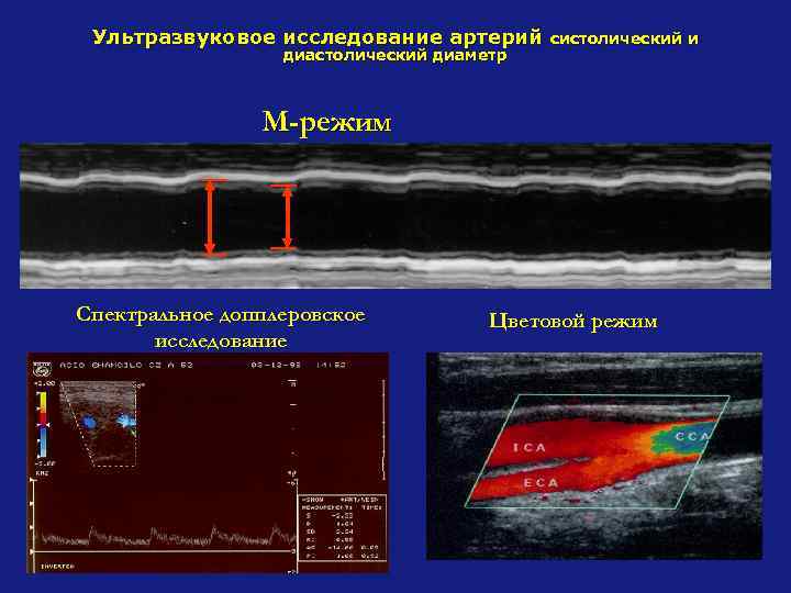Ультразвуковое исследование артерий диастолический диаметр систолический и М-режим Спектральное допплеровское исследование Цветовой режим 